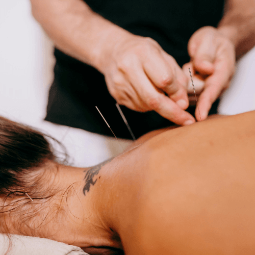 Clinician performing dry needling on a patient’s neck to treat cervical muscle strain.