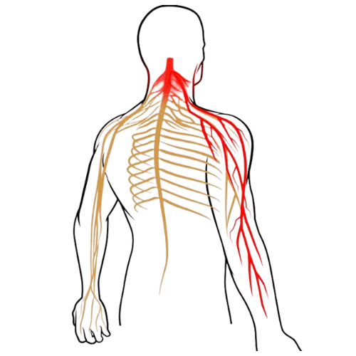 Medical illustration showing cervical nerve root compression causing radiating pain from the neck into the shoulder and arm.
