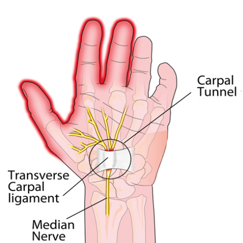 Medical illustration showing compression of the median nerve within the carpal tunnel at the wrist.