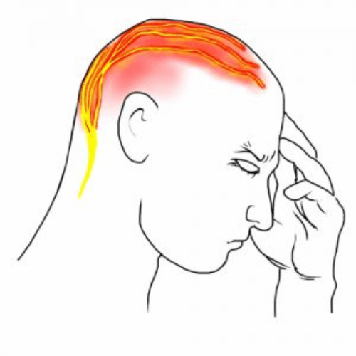 Medical illustration showing pain radiating from the upper neck to the back and top of the head in a person with a cervicogenic headache.