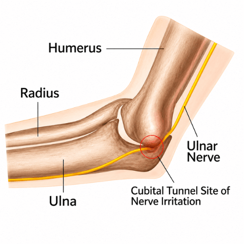 Medical illustration showing the ulnar nerve compressed in the cubital tunnel at the inner elbow.