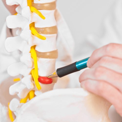 Anatomical spine model illustrating a disc bulge or herniated disc pressing against a spinal nerve.