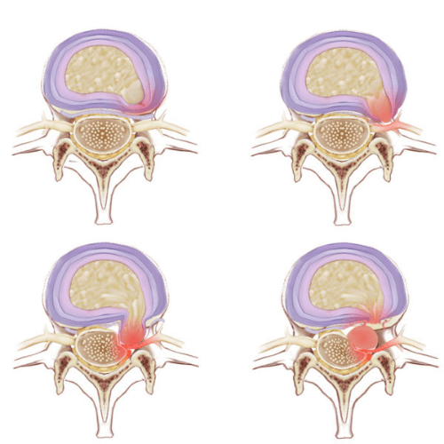 Medical illustration comparing four types of lumbar disc injuries, including bulging, protruded, extruded, and sequestered discs affecting spinal nerves.