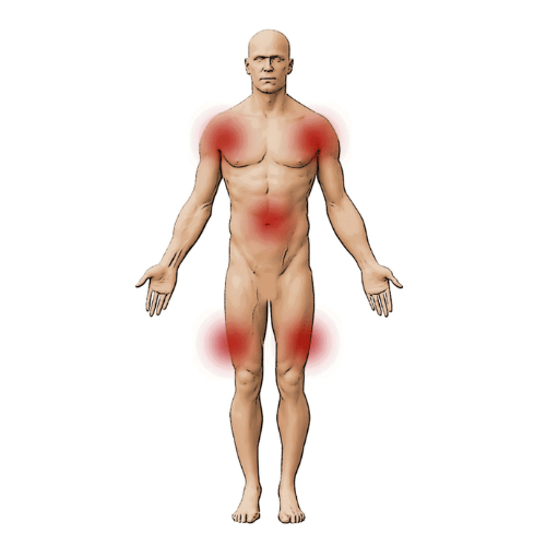 Medical illustration showing the common areas of widespread pain associated with fibromyalgia, including the shoulders, chest, lower back, hips, and knees.