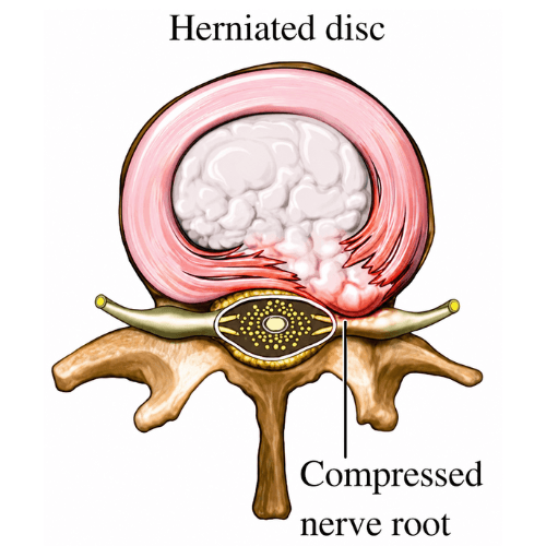 Medical illustration showing a lumbar herniated disc compressing a spinal nerve root.
