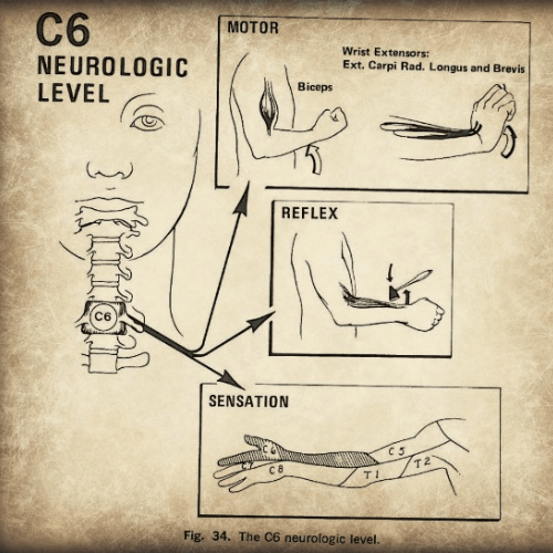 Medical illustration showing the motor, reflex, and sensory findings associated with C6 cervical radiculopathy.