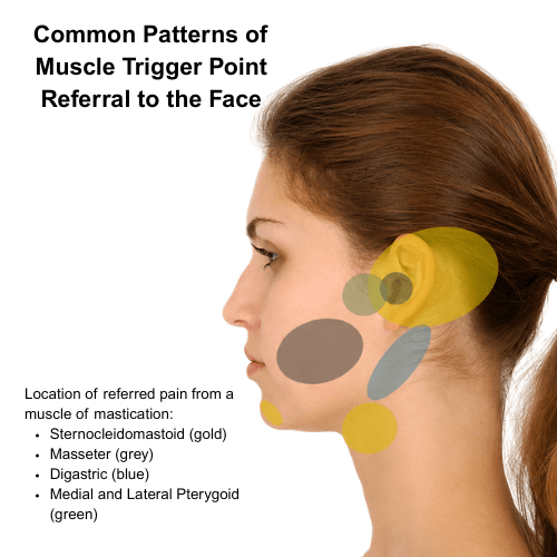 Medical illustration showing common facial pain referral patterns from muscle trigger points associated with temporomandibular disorder (TMD).