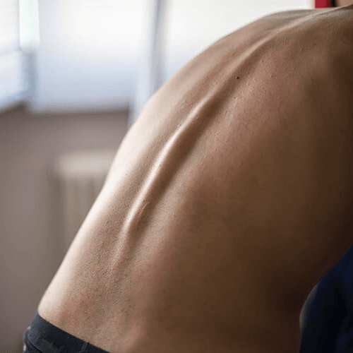 Close-up of a person's lower back illustrating the lumbar region commonly affected by chronic low back pain.