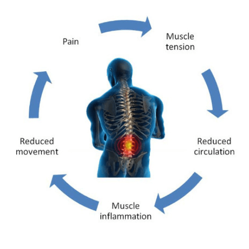 Diagram showing the pain cycle of muscle tension, reduced circulation, muscle inflammation, reduced movement, and recurring pain.