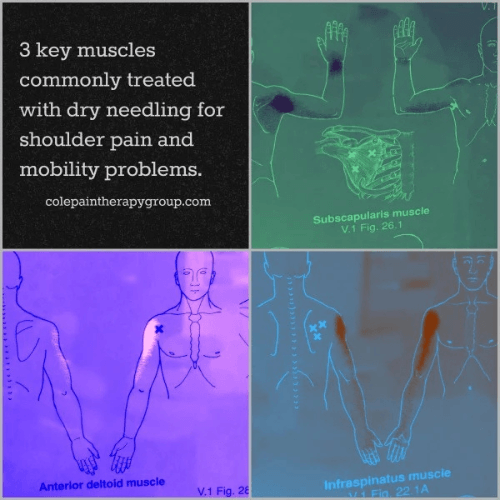 Medical illustration showing the subscapularis, anterior deltoid, and infraspinatus muscles commonly treated with dry needling for shoulder pain.