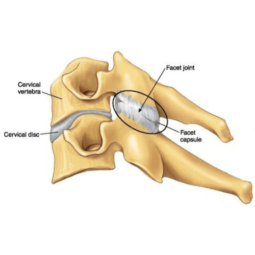 Medical illustration of the cervical spine highlighting the facet joint and facet capsule commonly injured during whiplash.