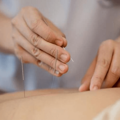 Clinician performing dry needling therapy by inserting thin needles into a patient's muscle to address pain and trigger points.