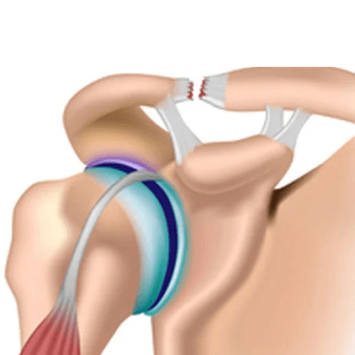 Medical illustration showing an acromioclavicular joint sprain with ligament damage and separation between the collarbone and shoulder blade.
