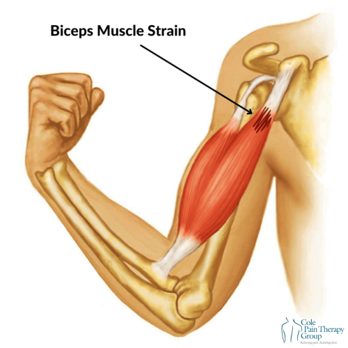 An anatomical illustration depicting a biceps muscle strain in the upper arm.