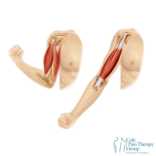 Illustration of biceps tendinopathy showing inflamed tendons and muscle anatomy in flexed and extended positions.