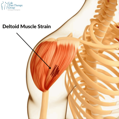 An anatomical illustration showing a deltoid muscle strain in the shoulder region.