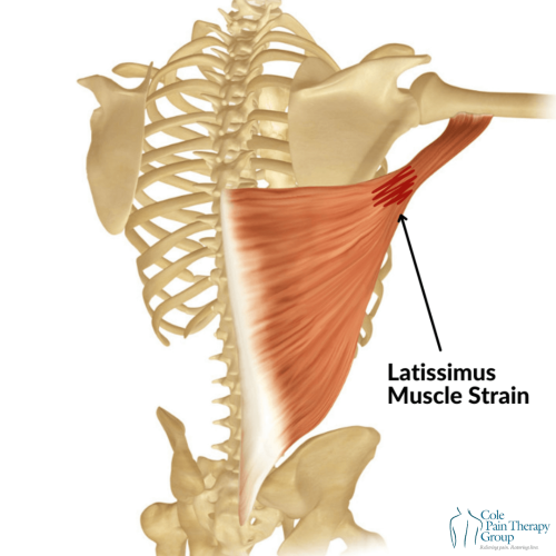 An anatomical illustration showing a latissimus muscle strain in the back and shoulder area.