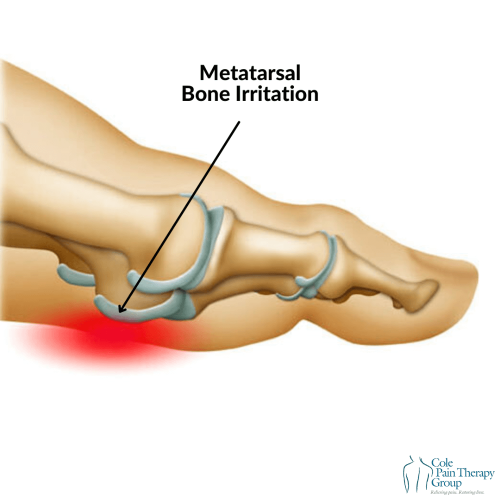 Illustration of metatarsal bone irritation with a red highlight, representing metatarsalgia.
