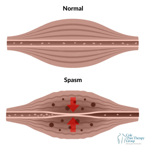 Illustration comparing a normal muscle and a muscle spasm, showing tightened fibers and contraction points in the spasm.