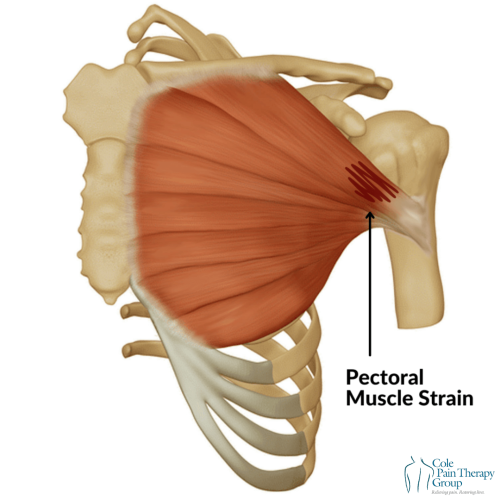 An anatomical illustration showing a pectoral muscle strain in the upper chest region.
