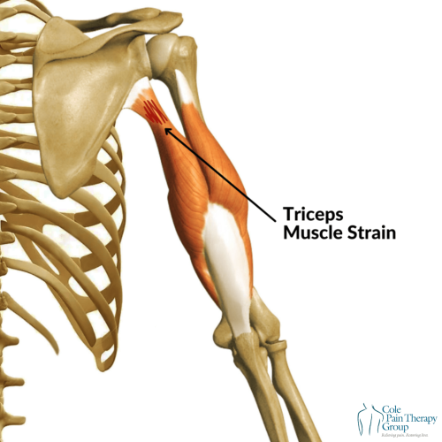 An anatomical illustration of the upper arm highlighting a triceps muscle strain.