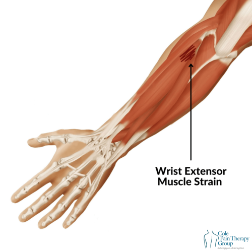 An anatomical illustration of the forearm highlighting a wrist extensor muscle strain.