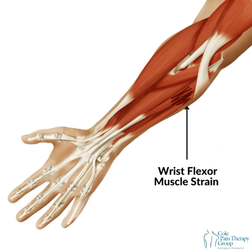 An anatomical illustration of a wrist flexor muscle strain in the forearm.