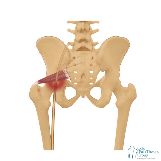 Diagram of Piriformis Syndrome showing the piriformis muscle compressing the sciatic nerve, with inflammation highlighted in red.